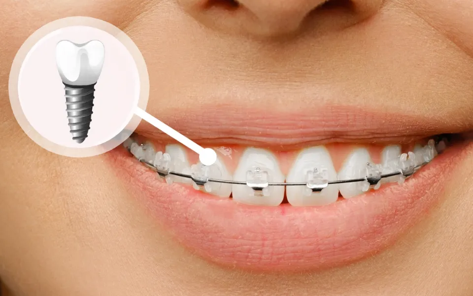 インプラントと全顎矯正