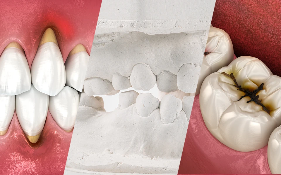 虫歯・歯周病も同時に治す包括的矯正