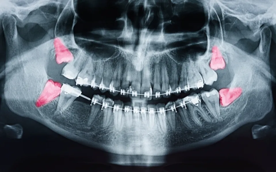 親知らずを抜かずに奥歯として活用する矯正