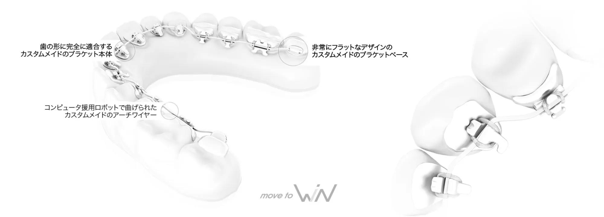 薄く精密なブラケットを作製 複雑な歯の形に合わせたオーダーメイド矯正