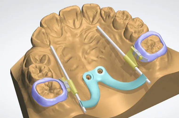 CAD/CAM技術を駆使した<br>アンカースクリュー連結型3Dメタルプリント矯正装置