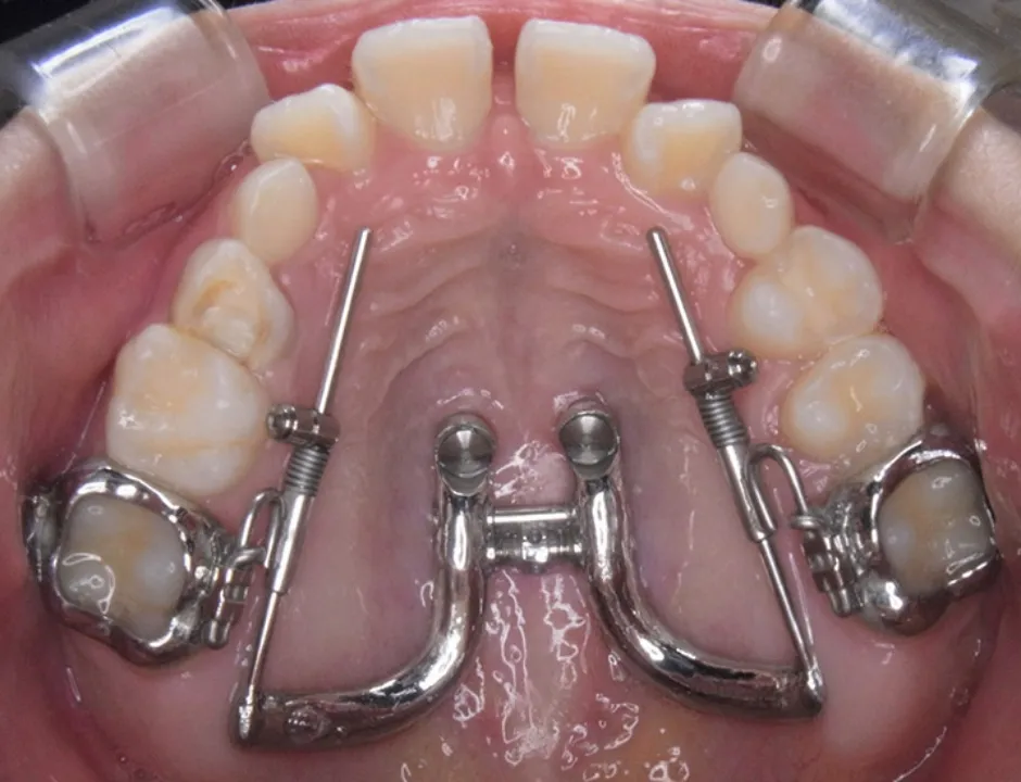 SHU-lider®; EX(拡大)