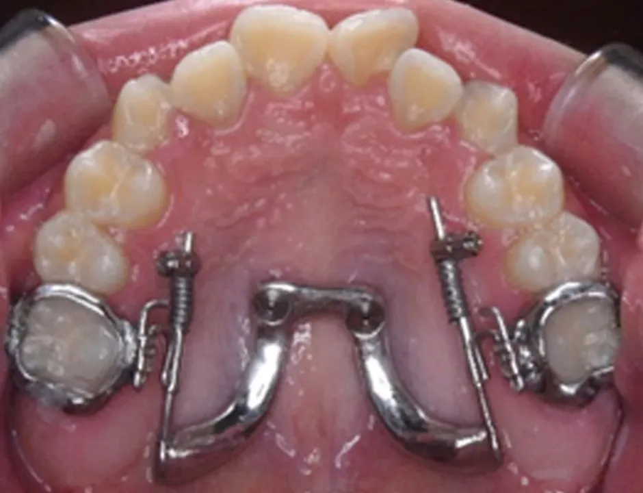 SHU-lider® RE(後方)