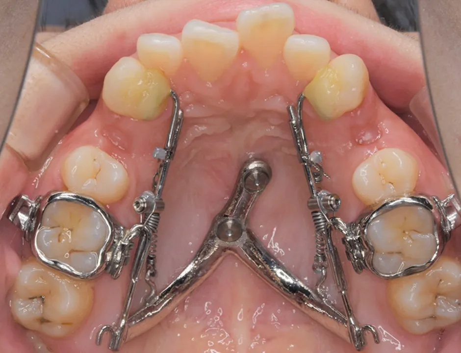 SHU-lider®+ アライナー装置(マウスピース矯正)