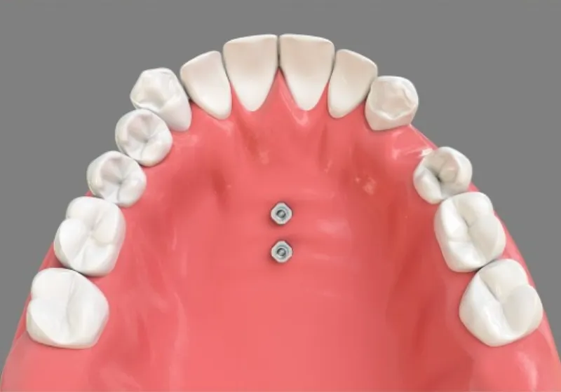 アンカースクリューを埋め込む