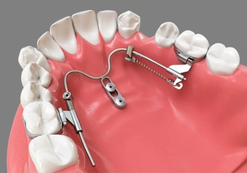 歯を移動させる