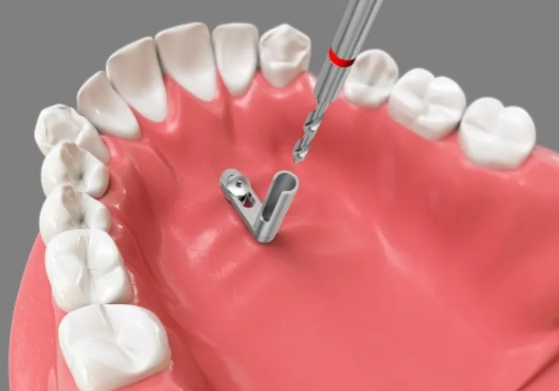 アンカースクリューの取り外し
