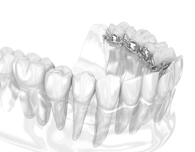 前歯を効果的に後方へ移動できる