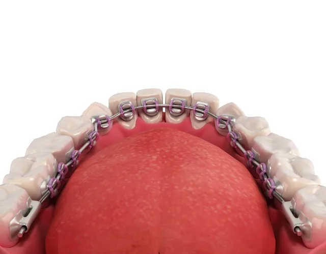 舌の癖による後戻りを防ぎやすい