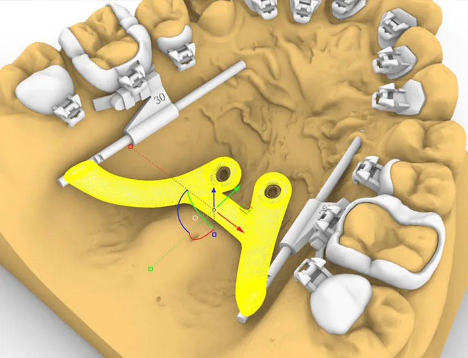 3Dメタルプリント矯正装置とのコンビネーション