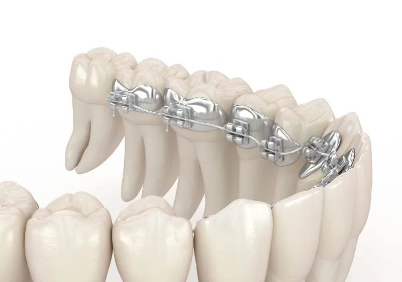 矯正装置の作製・装着、治療開始