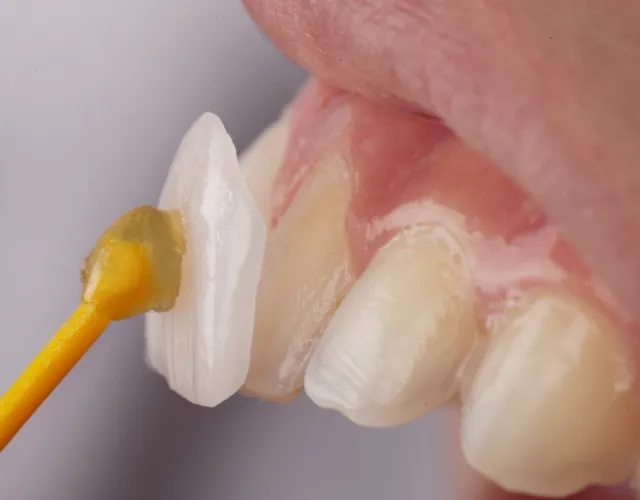 通常の矯正治療より治療期間が短い