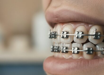 ワイヤー矯正の治療の流れ|初診から装置装着・調整までのステップ